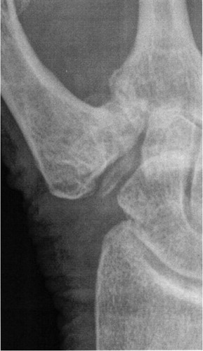 Figure 2. A remnant of the trapezium in the resection cavity after LRTI with APL.