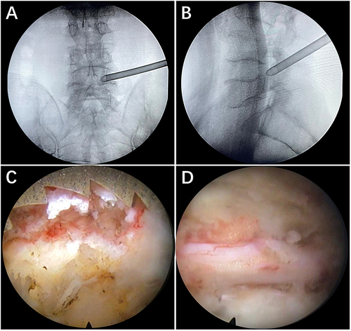 Figure 1 Foraminoplasty. (A) The cannula is placed on the medial border of the pedicle on the anteroposterior view. (B) The cannula is placed on the posterior border of the vertebral body on the lateral view. (C) The trephineis used again to further enlarge the aperture under endoscopy. (D) Nerve roots exposed in clear view.