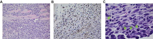 Figure 3. Palygorskite does not cause MM in vivo. MM was diagnosed in tissues taken from Balb/c mice after they were injected twice, 1 wk apart, with 1 mg glass, palygorskite, or crocidolite, or from MexTAg mice after they were injected twice, 1 mo apart, with 6 mg glass or palygorskite, or 3 mg crocidolite. MM visible in hematoxylin and eosin (H&E)-stained diaphragm tissue from Balb/c mouse exposed to crocidolite for approximately 8 mo (A). Presence of MM was confirmed by positive nuclear WT1 staining in a serial tissue section (B). Under higher magnification, aberrant mitosis (green arrows) was observed in MM cells infiltrating the diaphragm of MexTAg mouse exposed to crocidolite for 6 mo or more (C). Magnification 400× for (A) and (B), and 1000× for (C).