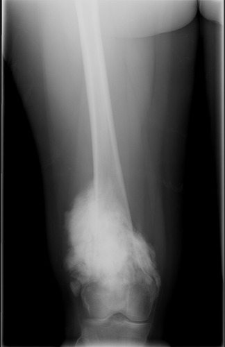 Figure 1 Distal femur radiograph.
