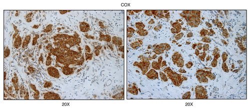 Figure 6 Mitochondrial complex IV (COX) activity is amplified in human epithelial cancer cells, in breast cancer patients (low-power images). Frozen sections of human breast cancer samples were subjected to COX activity staining (brown color). Slides were then counter-stained with hematoxylin (blue color). Note that human epithelial tumor cells are intensely stained, as compared with adjacent stromal cells, which show little or no COX activity, in comparison. Original magnification, 20x, as indicated.