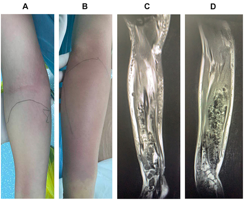 Figure 1 (A and B) Redness and swelling of the forearm. (C and D) MRI revealed marked forearm muscle swelling, heterogeneous signal intensity and shadowing suggestive of gas.