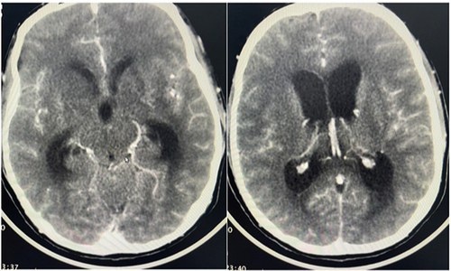 Figure 3 A repeat contrast CT of the brain showed enhancement in basal cistern and hydrocephalus.