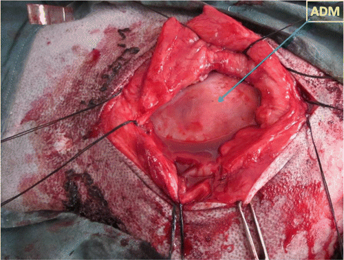 Figure 2.  Intraoperative image showing placement of ADM to the peritoneum after tying of the sutures on the external sheath of rectus abdominis muscle.