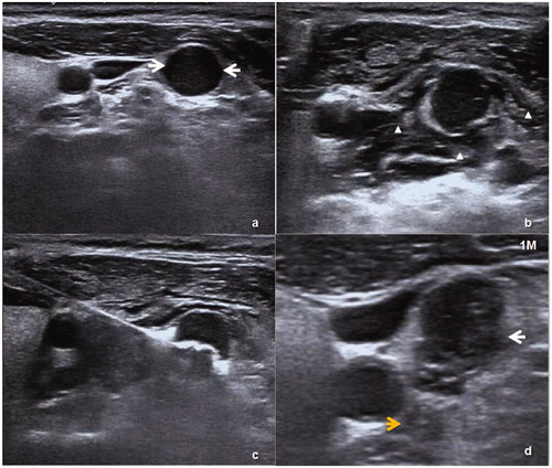 Figure 3. (a) An ectopic parathyroid nodule (white arrow) was on the lateral side of the left carotid sheath. (b) A liquid-isolating zone around the nodule (white triangle). (c) The procedure of MWA. (d) One month after MWA, the nodule showed a reduction in volume on US and the ablation zone (white arrow) was close to middle cervical sympathetic ganglion (MCSG) (yellow arrow).