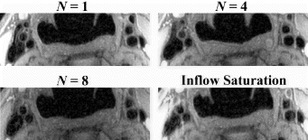 Figure 1. PD-weighted images obtained from a healthy volunteer using DIR-FSE method with different N and FSE with inflow saturation.