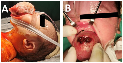 Figure 3. Open tracheostomy and examination under anesthesia (EUA) and biopsy performed on day 7 of life (A) Lateral view of the huge tongue mass, (B) Anterior view of huge tongue mass.