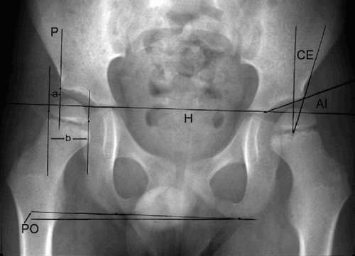 Figure 1. A 6-year-old boy with diplegia, showing the radiographic measurements.The migration percentage (MP) is the lateral displacement of the femoral head (a/b × 100).The other radiographic parameters are indicated (AI:acetabular index;CE:center-edge angle;PO:pelvic obliquity).H is Hilgenreiner's line and P is Perkins'line.AI is the slope of the acetabular roof, which is the angle between the acetabular roof and Hilgenreiner's line.The CE angle is the angle between the perpendicular line through the center of the femoral head and the line between this and the lateral acetabular rim.