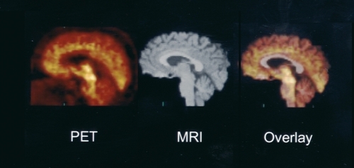 Figure 2. Combined structural and functional imaging. The sagittal brain image (left) illustrates the distribution of 5-HT transporter binding sites imaged with positron emission tomography (PET) and [11C](+)-McN5652 (summed over 40 to 90 min postinjection). High-resolution T1-weighted magnetic resonance imaging (MRI) (middle) provides detailed anatomic information. However, the coregistration of the PET and MRI depicted in the overlay image (right) offers a unique combination of structural and functional data. The localization of the raphe nuclei, which are not visible by MRI alone, are functionally and anatomically defined by the coregistered images.