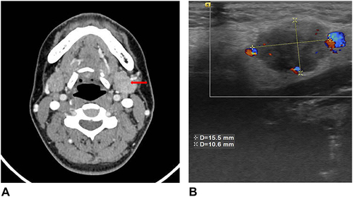 Figure 1 Computed tomography scan showing an enhanced mass located in the left submandibular gland. Red arrows: sebaceous carcinoma mass (A). Ultrasound examination revealed a mixed-component nodule in the left submandibular gland (B).