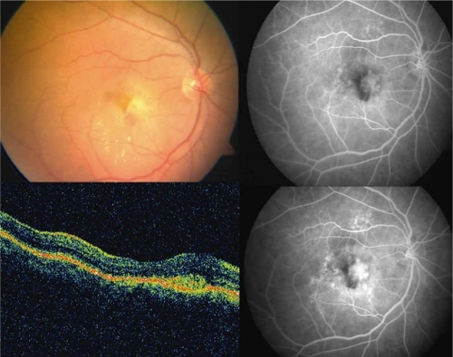 Figure 3 Case 2: Color fundus photograph of the right eye (upper left) shows a yellowish-gray subfoveal lesion suggestive of choroidal neovascularization with specks of fresh subretinal hemorrhage. Early hyperfluoresence with intense late staining on fundus fluorescein angiography confirms the presence of predominantly classic choroidal neovascularization (upper right and lower right); blocked fluorescence corresponds to subretinal hemorrhage. Optical coherence tomography scan reveals the presence of a high reflective, spindle-shaped lesion in the subretinal area abutting the fovea with increased overlying retinal thickness (lower left).