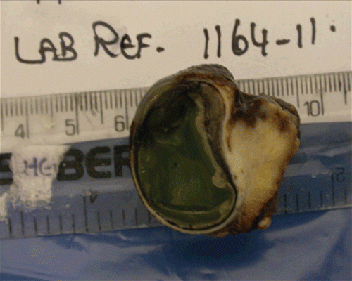 FIGURE 5  Gross specimen of the enucleated eye showing thickened choroids with a whitish mass adherent to the globe nasally.