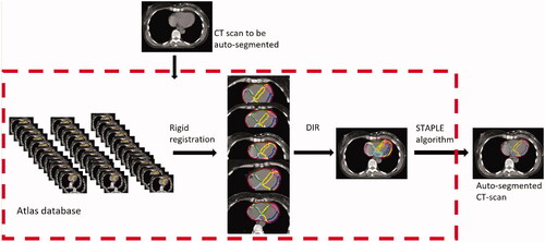 Figure 1. The process of auto-segmentation consists of three steps. (1) A rigid registration between the CT scans in the atlas database and the CT scan to be auto-segmented aiming to obtain the five CT scans with the highest anatomical match. However, for auto-segmentation of the left ventricle wall, only three subjects were used as this resulted in a higher delineation consistency than when using five subjects. (2) The selected CT scans were submitted to the deformable image registration (DIR) algorithm where the suggestion for each structure for the selected patients were transferred to the new CT scan. (3) Finally, the simultaneous truth and performance level estimation (STAPLE) algorithm was used to collapse the multiple delineations into one delineation.