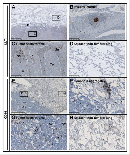 Figure 1. Expression of LLT1 and CD161 in NSCLC tumors. (A-H) Hematoxylin (HE) counterstained IHC stainings of (A-D) FFPE and (E-H) frozen sections of two representative tumors from untreated NSCLC patients using (A-D) anti-human LLT1 clone 2F1 and (E-H) anti-human CD161 clone DX12. (B-D) represent higher magnifications (x100) of areas (black rectangles) in (A) (magnification x10). (F-H) represent higher magnifications (x100) of areas (black rectangles) in (E) (magnification x10). (A-D) Solid adenocarcinoma (ADC) subtype. (E-H) Lepidic ADC subtype. Str, Stroma; Tu, Tumor Nests.