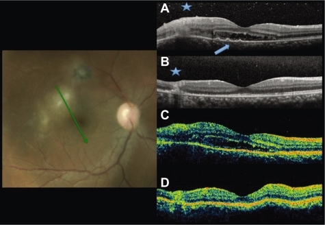 Figure 1 Fundus photography and radial scans at baseline by SD-OCT A) and TD-OCT C). Increased thickness and disorganization of the retinal layers at the lesion site at A and C (asterisk). Subretinal fluid at the foveal area. Small RPE detachments (arrowhead) only in A. Six-week follow up images by SD-OCT B) and TD-OCT D) show resolution of the subretinal fluid and decrease of the retinal thickness at the lesion site.