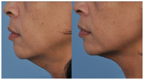 Figure 2 This patient achieved significant skin tightening in the neck area following microfocused ultrasound with visualization.
