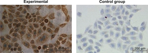 Figure 1 Immunohistochemical examination of EGFR expression on the membrane and in the cytoplasm of BcaCD885 cells in the experimental group and control group (the primary antibody was replaced by PBS) (SP × 200).Abbreviations: BcaCD885, human buccal squamous cell carcinoma cell line; EGFR, epidermal growth factor receptor; PBS, phosphate buffered saline; SP, streptavidin peroxidase.