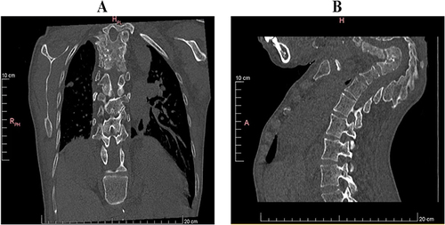 Figure 1 Plain CT scan of the patient’s chest and abdomen ((A): Spinal AP and lateral position (B): Spinal lateral position).