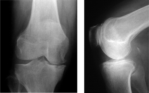 Figure 2. Plain anteroposterior and lateral radiographs showing focal osteonecrosis of the medial tibial plateau.