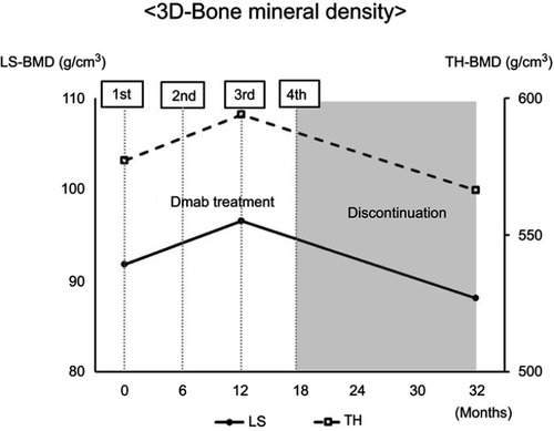 Figure 3 3D-BMD levels measured by QCT. QCT revealed that there was a significant decrease in bone mineral density after discontinuation of denosumab treatment.