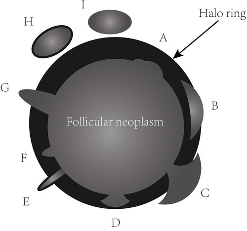 Figure 1 The thick, irregular and/or interrupted halo ring with or without satellite nodule(s) due to tumor invasion of capsule. The feature of A site can be seen in both follicular adenomas and carcinomas. The features of B, C, E, G, H and I sites can only be observed in follicular carcinomas. B and C features can be presented in different sections of mushroom-shaped tumor bud of follicular carcinoma. Satellite nodules with or without halo ring (H and I). Tumor bud clothed by a thin halo ring (E). D and F are suspicious features of follicular carcinoma.