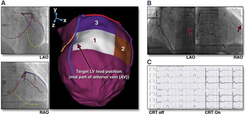 Figure 4. (A) Target venous site for LV lead placement. Major LV veins were drawn on fluoroscopic venograms, reconstructed to a 3D structure, and fused with SPECT LV epicardial surface. The mid part of AV (blue line) was aligned with the optimal segment (white segment), and so was targeted for lead placement. (B) Post-implant fluoroscopy. The LV lead was placed using the guidance in (A). The post-implant images show that the LV lead (red arrows) was on target. (C) Post-implant electrocardiogram. The QRS duration decreased from 168 to 140 ms immediately after the cardiac resynchronization therapy (CRT) device was turned on. RAO 1⁄4 right anterior oblique. Reproduced with permission from Elsevier.
