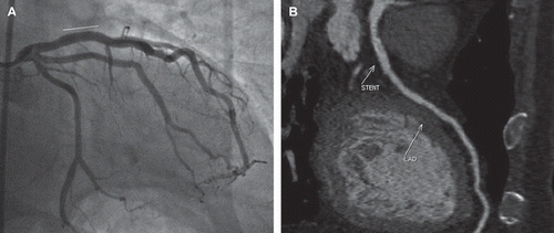 Figure 2. (A) ICA of LAD post stenting (white line denoting site of stent). (B) CCTA of LAD showing widely patent proximal LAD stent with minimal blooming artifact (site of stent denoted by arrow); image generated with a sharp kernel (B46f, Heartview, Siemens).