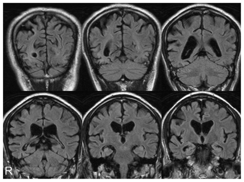 Figure 4 Magnetic resonance imaging coronal sections of fluid-attenuated inversion recovery images 11 months after first examination showed progression of temporo-parieto-occipital lobe atrophy with right-side dominance.