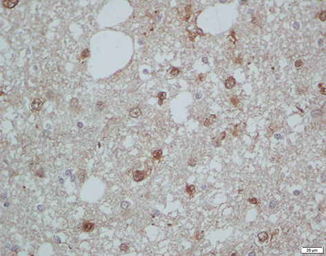 Figure 1 Immunohistochemistry staining for IDH1 (patient with diffuse astrocytoma). IHC staining of one tumor sample with IDH1 mutated.