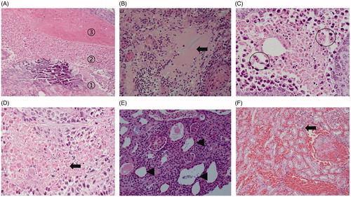 Figure 10. Histopathological findings of the renal ablation zone determined by HE staining. (A) The ablation zone was divided into three different zones: coagulation necrosis of tumor nests ①, coagulation necrosis of normal renal parenchyma ②, and congestion and edema band③. (B) Pink exudate was found in the coagulation necrosis area of normal renal parenchyma (black arrow). (C) Markedly dilated spaces between the cords of neoplastic cells (circles). (D) Coagulation necrosis area of the tumor showed a residual cell outline with karyolysis (black arrow). (E) Tubular dilatation was found in the tumor coagulation necrosis area (black triangle). (F) Infiltration of lymphocytes (black arrow) in the hemorrhagic zone (A, ×4; B, E, and F, ×20; C and D, ×40 magnification).