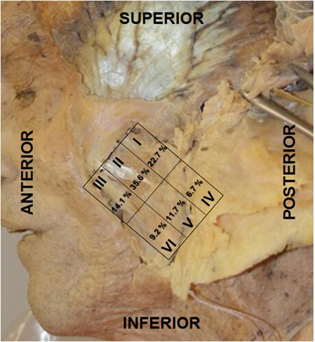 Figure 3 Sextant left masseter muscle. Percentage of nerve entry points by area. Areas numbered from I–VI, where I–III are superior and IV–VI are inferior in the posterior to anterior direction, respectively.