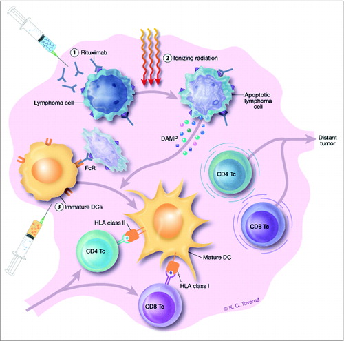 Figure 1. Schedule for intranodal immunotherapy and proposed mechanism of action. Rituximab (5 mg) is injected into a solitary lymphoma node or lesion on days 1 and 3 (1). Rituximab induces apoptosis in CD20-expressing lymphoma cells, sensitizes them to RT of 8 Gy targeting the same site and administered on day 2 (2), and mediates FcR-binding and uptake of lymphoma cells by immature DCs (5–10 × 107) injected into the irradiated lesion on days 4 and 5 (3). The irradiation induces the expression and release of damage-associated molecular patterns (DAMPs) by the lymphoma cells, which in turn mediates maturation of the DCs. DCs present tumor antigens from the lymphoma cells to tumor-reactive CD4 and CD8 T cells, resulting in activation and migration of the T cells to distant tumor nodes. The treatment schedule was performed 3 times, at weeks 1, 3 and 5, targeting a different lymphoma lesion each week.