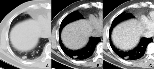 Figure 5 A patient with a history of diabetes mellitus for 15 years and pulmonary aspergillus. (A and B) axial plain CT images show an oval and well-defined solid nodule located in the right lower lobe (CT value = 14HU). On enhanced CT image (C), it has no significant enhancement (CT value = 15HU).