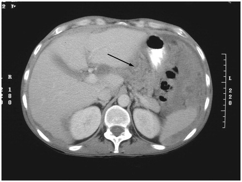 Figure 11. CT slice showing tumour ≥5 cm in diameter in gastrohepatic ligament.