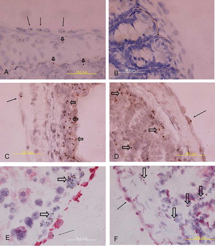Figure 2. (A) Y-chromosome+ cells were identified in serosa (arrows) as well as in stroma (hollow arrowhead) of intestine in male positive control. (B) No Y-chromosome+ cells were found in female negative control. (C and D) A few Y-chromosome+ cells (arrow) were found on intestinal serosa of recipients. Alternatively, plenty of Y-chromosome+ leukocyte (hollow arrowhead) existed in the stroma of intestine. (E) Y-chromosome+ cell (brown color, arrow) in peritoneum of the liver also expressed cytokeratin marker (red color); however, Y-chromosome+ leukocyte (hollow arrowhead) in submesothelial area were negative for cytokeratin staining. (F) Y-chromosome+ cell (arrow) in intestinal serosa of recipient was also positive for cytokeratin staining (weakly staining of Vector Red following pepsin treatment in the in situ hybridization procedure), however, several Y-chromosome+ leukocyte (hollow arrowhead) in stroma were negative for cytokeratin.