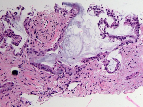 Figure 1 Representative histologic image from a needle biopsy of a 3.7 cm left lower lobe lung lesion (October 2015). H&E stained slides show well- to moderately differentiated adenocarcinoma with predominantly acinar growth pattern and associated psammomatous calcifications. (20x, H&E).