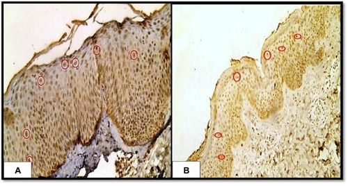 Figure 3 Showing co-localization of the both E-selectin (A) and galectin-9; (B) immunohistochemical nucleo-cytoplasmic expression (red circles in both (A and B) in the epidermis of a case of atopic dermatitis (immunoperoxidase 200 × HPF [A], 40 × HPF [B]).
