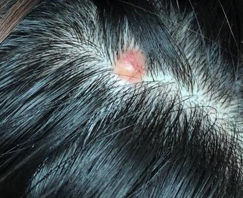 Figure 1 There was an exophytic papule on her scalp in size of 8×9mm, and multiple telangiectatic vessels were seen on the surface.