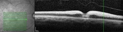 Figure 2 OCT image showing hyperreflectivity and increased thickness of the inner retina in CRAO.