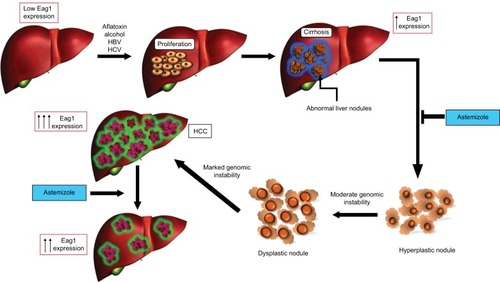 Figure 1 Eag1 expression in the progression of HCC.