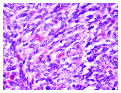 Figure 4. HH&E stained section of a small round cell lung tumor-primary pulmonary tumor (PNET).