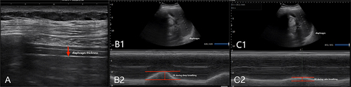 Figure 1 Using the liver as an acoustic window. (A) Represents the diaphragm thickness. (B) Represents the diaphragm excursion during deep breathing. (C) Represents the diaphragm excursion during calm breathing.