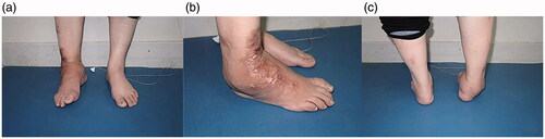 Figure 1. The appearance of the patient’s right ankle. The ankle was swollen (a, b) and distorted (c). The skin on the back of right foot (b) was scared seriously because of one fire accident before.