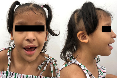 Figure 1 Colombian patient with MWS. Seven-year-old female with long face, sparse eyebrows, widely spaced eyes, downturned palpebral fissures, short columella, low-set and posteriorly rotated ears.