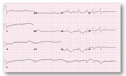 Figure 1. Wide complex undetermined atrial rhythm at rate of 58 bpm with prolonged QT 666 msec and QTc of 653 msec.
