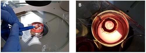 Figure 8. Digital images showing the implantation of a printed IOL-like device in a human capsular bag model in vitro. The delivery of the implant into the capsular bag can be seen in image (A). Once implanted in the capsular bag, the implant recovered its original shape without causing any deformation in this structure (B).