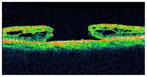 Figure 1 Preoperative – stage 3 macular hole.