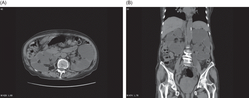 Figure 2.  Computed tomography scan showing bilateral hydroureteronephrosis with nearly absence of renal cortex (A: transverse view, B: coronal view).