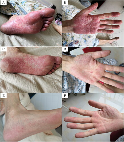 Figure 2. (A) (B) Two months after osimertinib treatment: multiple rashes in the extremities, no itching, pain, and hypoesthesia; (C) (D) (E) (F) Rash gradually subsided.