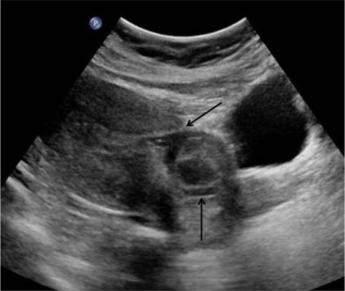 Figure 1 CSP demonstrated by ultrasound.